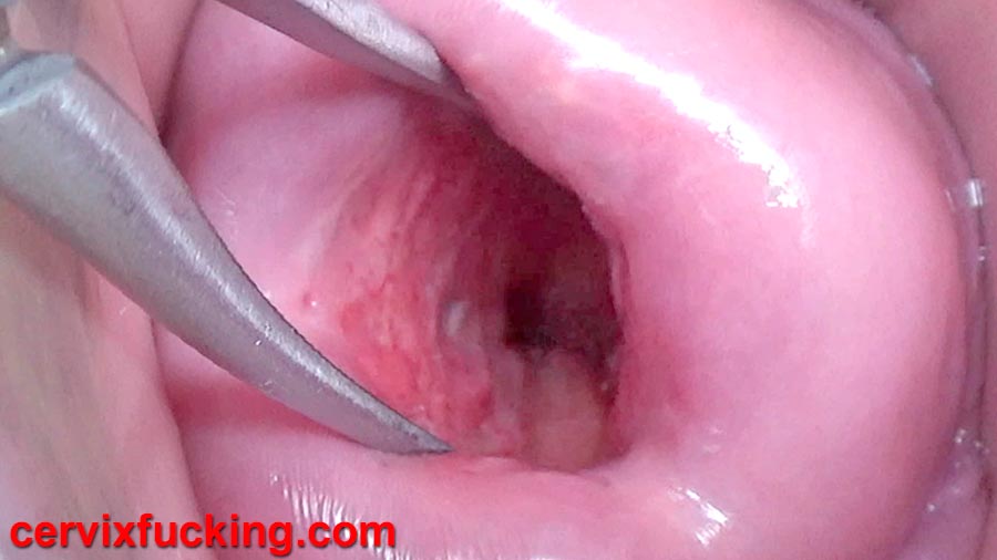 Japanese cervix stretched open wide to watch inside uterus